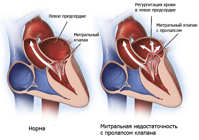 стеноз легочной артерии